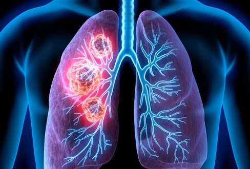 θεραπεία καρκίνος πνεύμονα