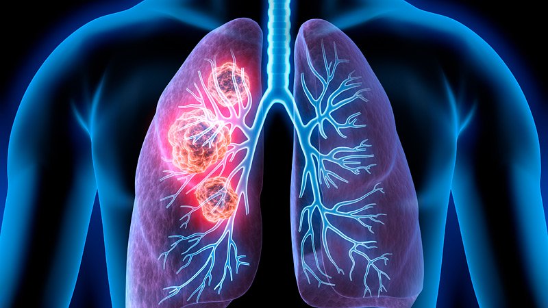 θεραπεία καρκίνος πνεύμονα