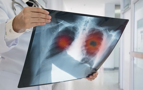 Γιατρός ελέγχει ακτινογραφία ασθενή για καρκίνο του πνεύμονα